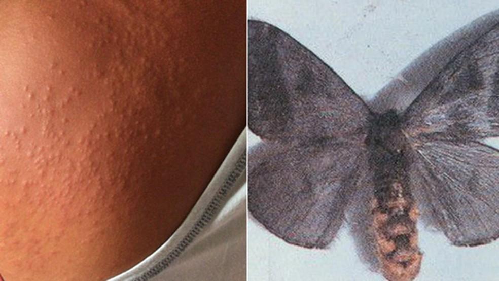 Infestação de mariposas causa surto de casos de dermatite alérgica