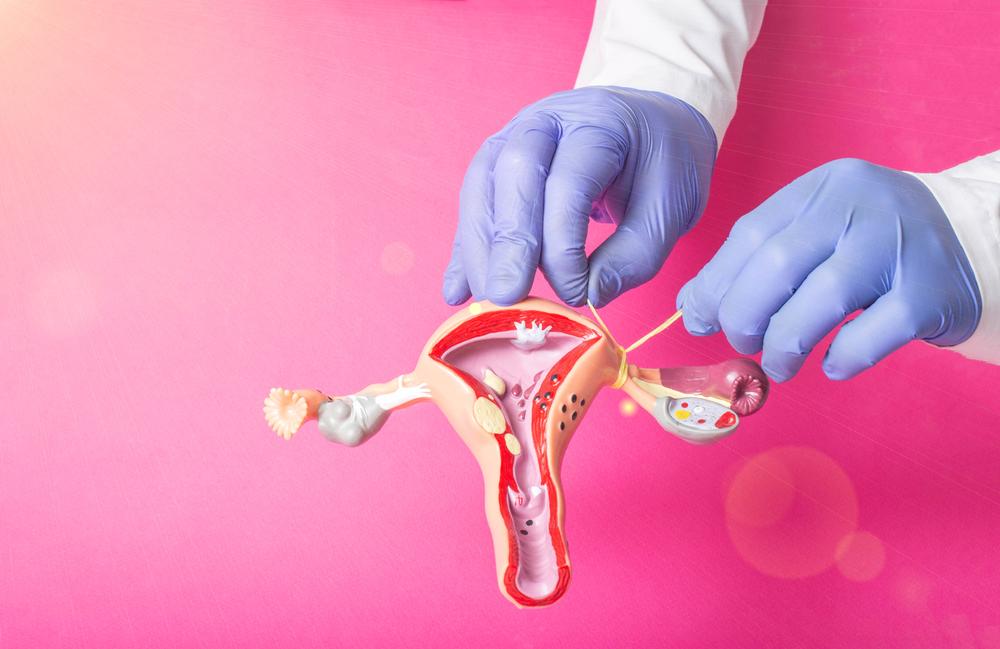 Não é mais necessário consentimento do cônjuge para laqueadura e vasectomia