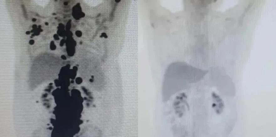 Nova terapia de reprogramação celular elimina câncer em homem em apenas 30 dias