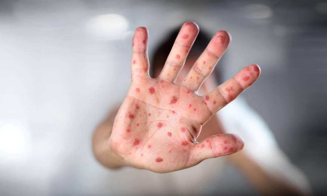 OMS alerta sobre crescente número de casos de sarampo