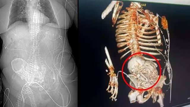 Idosa morre após cirurgia para remover feto calcificado carregado por mais de 50 anos