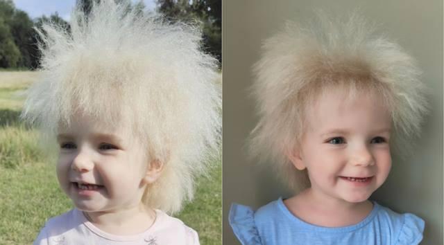 Saiba o que é a síndrome do cabelo impenteável