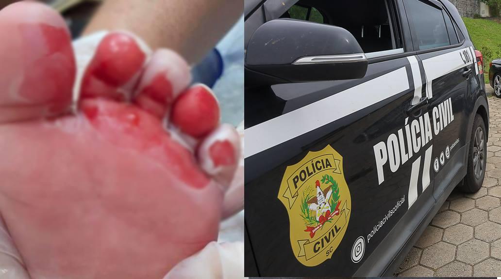 Bebê sofre lesões graves nos pés após banho em creche