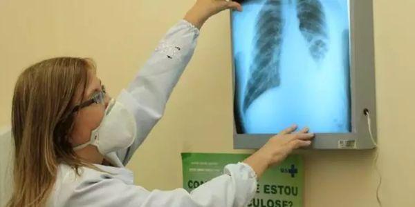 OMS alerta: tuberculose causa mais de 1,2 milhão de mortes por ano