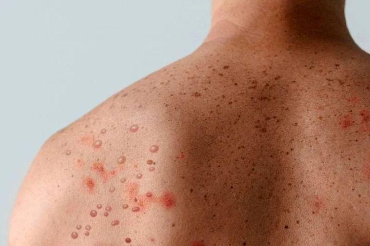 Porto Alegre confirma primeiro caso de Mpox em 2026