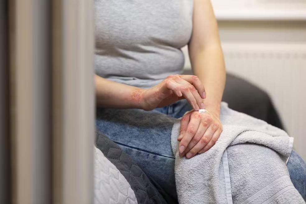 SUS passa a adotar antibiótico para prevenir sífilis e clamídia após exposição de risco